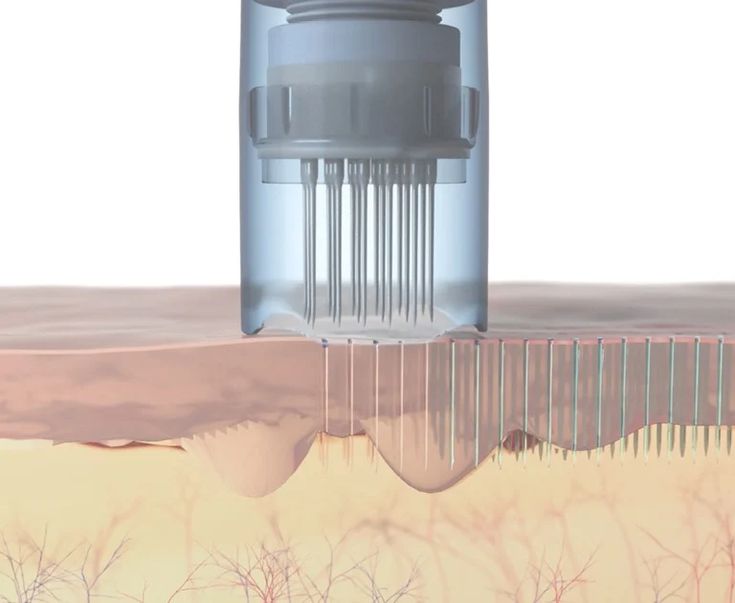 Guía de profundidades del dermapen: qué milímetro usar en cada zona - Dr Pen Colombia